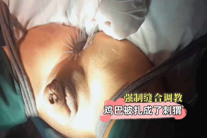 卧槽这鸡巴是犯了什么罪了竟然被扎成了刺猬 还被强制缝合了
